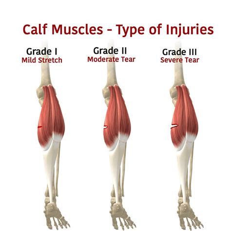 test for calf muscle tear|symptoms of torn calf muscle.